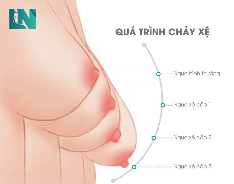 HẬU QUẢ KHÔN LƯỜNG CỦA VIỆC MẶC CHỌN SAI SIZE ÁO LÓT CỦA CÁC BÀ BẦU - CÁCH CHỌN SIZE ÁO LÓT 4 ngực chảy xệ